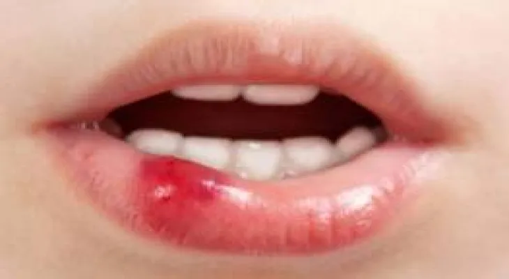 ces d'autres conséquences simples pouvant mener à un cancer de la bouche