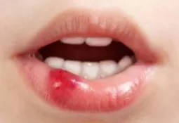 ces d'autres conséquences simples pouvant mener à un cancer de la bouche