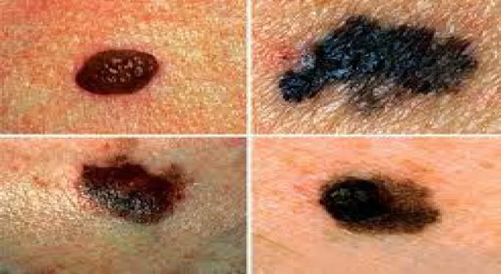 Sudbury council member talks about his story with skin cancer