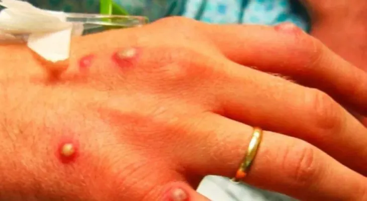 Monkeypox: Investigation into the appearance of several cases in the United States, Canada, and Europe