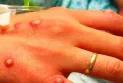 Monkeypox: Investigation into the appearance of several cases in the United States, Canada, and Europe