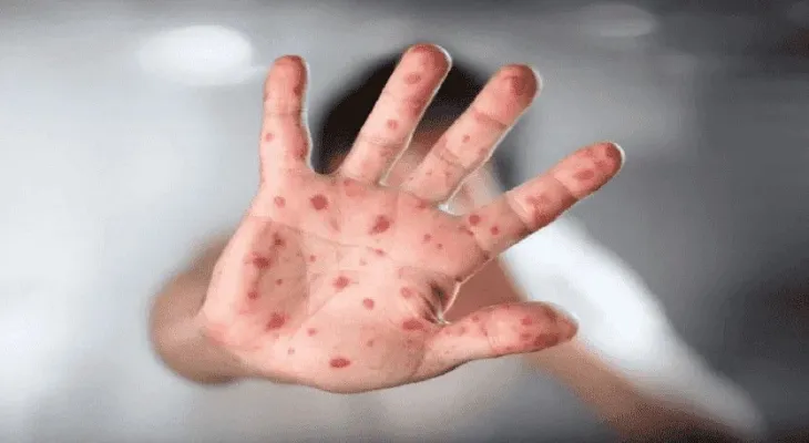 Canada announces 6 monkeypox cases.. 5 in Montreal and one in Toronto
