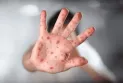 Canada announces 6 monkeypox cases.. 5 in Montreal and one in Toronto