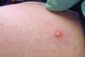 Morocco records first case of monkeypox