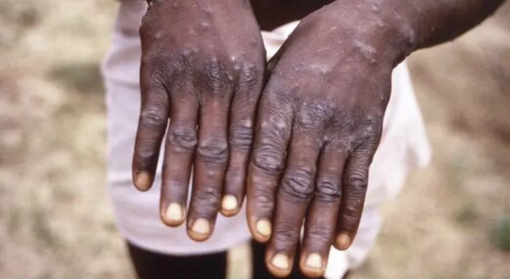 India: First possible monkeypox death recorded