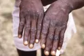 India: First possible monkeypox death recorded