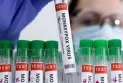 Monkeypox vaccination sites added in Alberta as confirmed cases rise