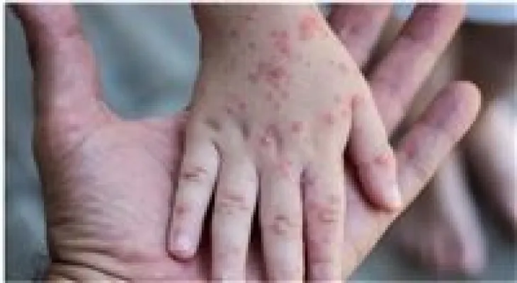 Canada denies plans to declare monkeypox a public health emergency
