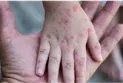 Canada denies plans to declare monkeypox a public health emergency