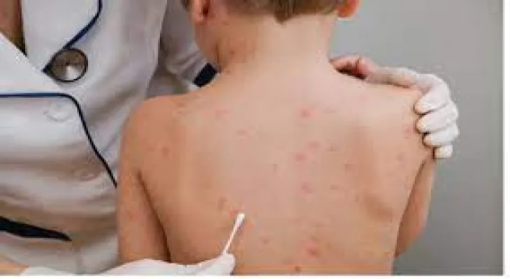 The first confirmed case of monkeypox in New Brunswick is not travel-related