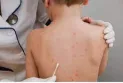 The first confirmed case of monkeypox in New Brunswick is not travel-related