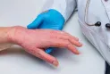 Two new cases of monkeypox have been found in the Brant area