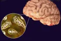 Centers for Disease Control: Brain-eating amoeba killed a child in Nebraska