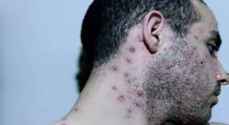 Nova Scotia announces first case of monkeypox
