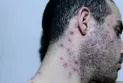 Nova Scotia announces first case of monkeypox