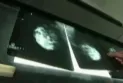 The Newfoundland Health Authority reviewed approximately 3,000 mammograms in search of potential problems.