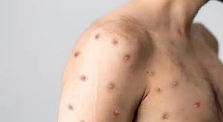 World Health Organization: 21% decrease in monkeypox cases worldwide