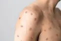 World Health Organization: 21% decrease in monkeypox cases worldwide