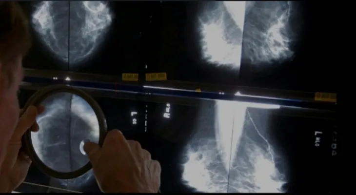 What is the most common cancer in Canada? Key points from the latest national report