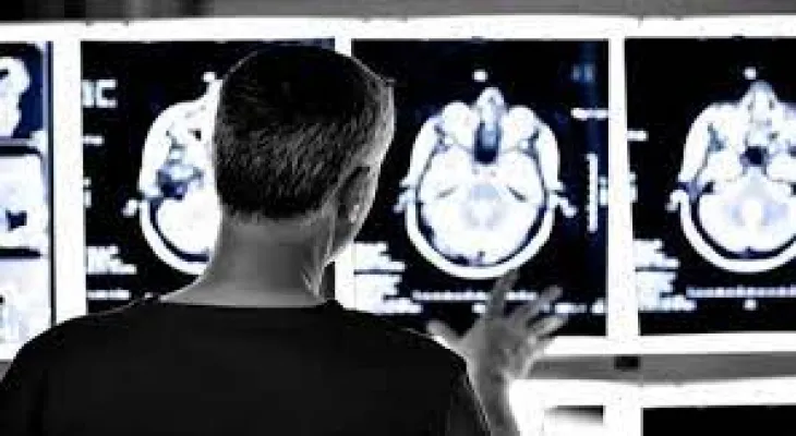 United States approves Alzheimer's drug and Canada follows