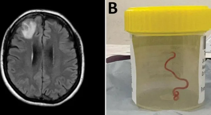 Scientists extract a live worm from the brain of an Australian woman