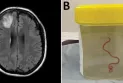 Scientists extract a live worm from the brain of an Australian woman