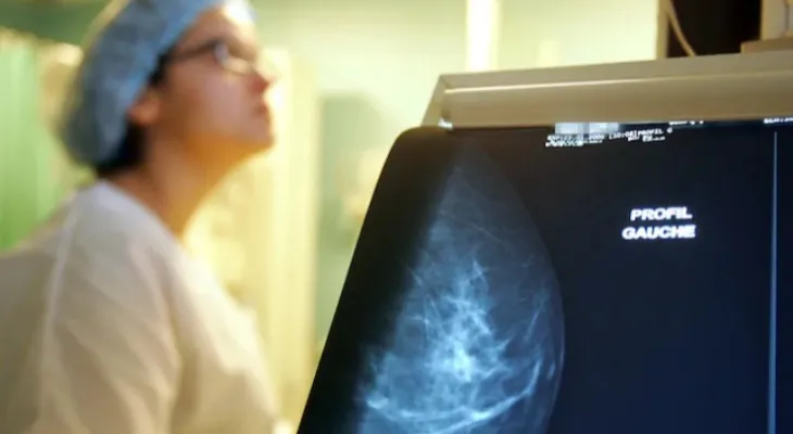 Ontario lowers breast cancer screening age to 40 years