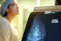 Ontario lowers breast cancer screening age to 40 years