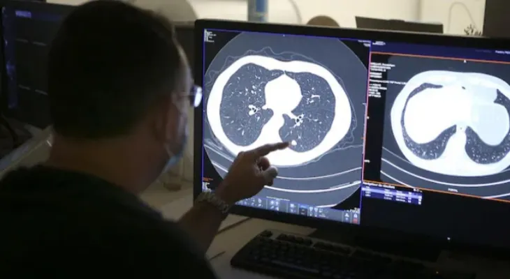 Decrease in lung cancer mortality rate in Canada