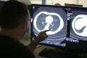 Decrease in lung cancer mortality rate in Canada