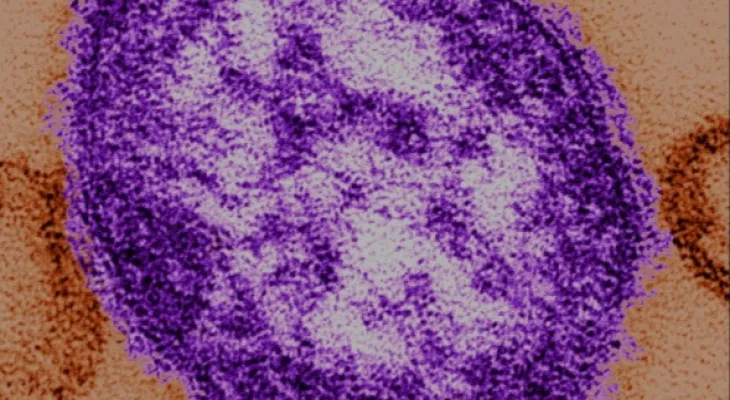 Alberta Health Services issues a measles alert in Calgary