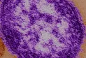 Alberta Health Services issues a measles alert in Calgary