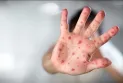 Infant transferred to a hospital in Toronto due to measles infection