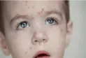 Warning of measles outbreak in Ontario