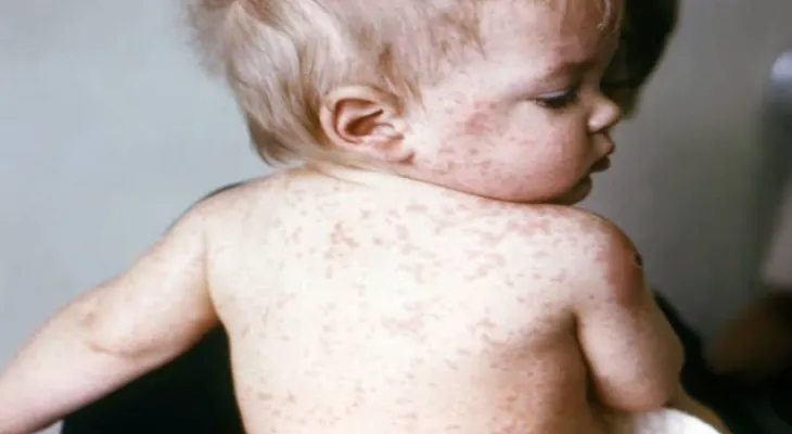 Police searching for man who spread measles in a Mississauga restaurant