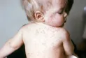 Canadian Public Health warns of the spread of the measles virus within the country