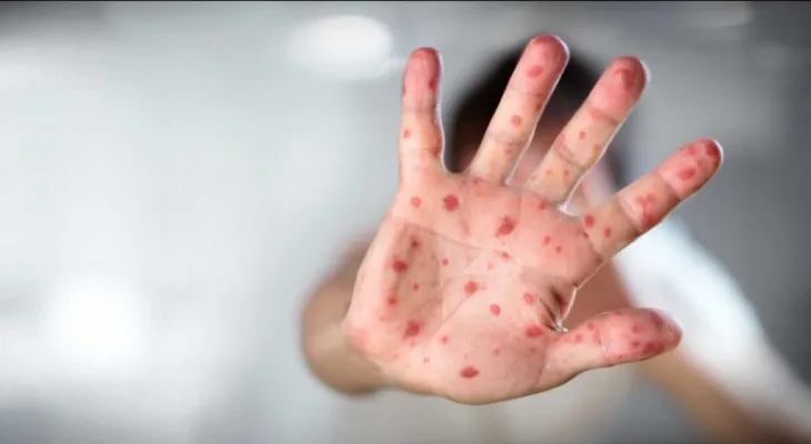 Ministry of Health: Reporting the first case of measles in British Columbia over the weekend