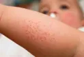Toronto urges travelers during the March break to check their measles vaccination status