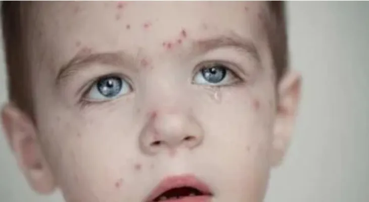 Increase in measles cases in Quebec to 18 cases