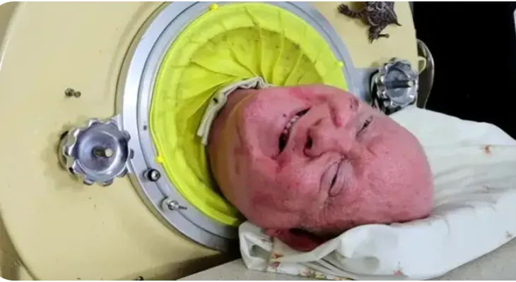 The death of Paul Alexander who spent 70 years inside the iron lung