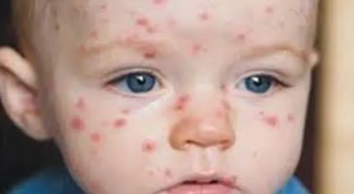Canada: 17 people infected with measles during March