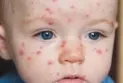 Canada: 17 people infected with measles during March