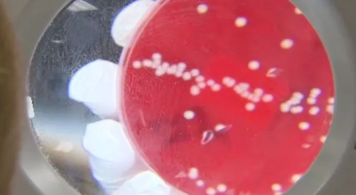 Increase in syphilis cases in Montreal
