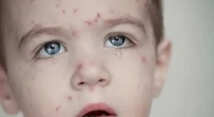 Concern in Canada after measles cases rise to 40 during 2024