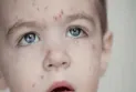 Concern in Canada after measles cases rise to 40 during 2024