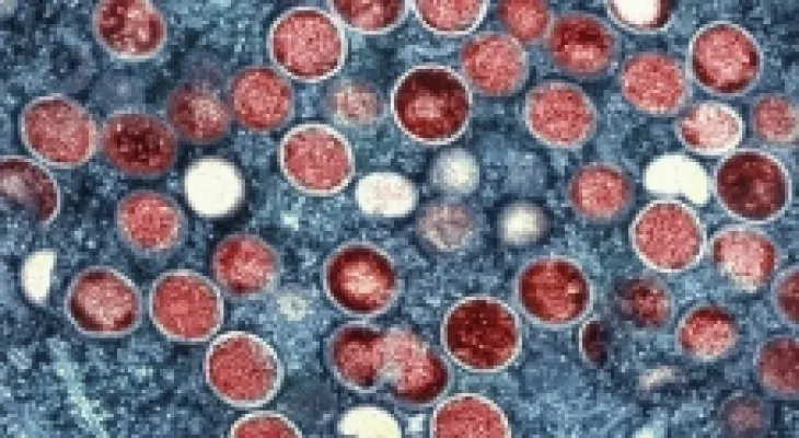 Ontario urges "monkeypox" testing amid rising case numbers