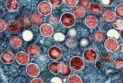 Ontario urges "monkeypox" testing amid rising case numbers