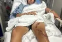 Je continue à faire des cauchemars.... Un jeune homme survit à la morsure de deux requins aux Bahamas.