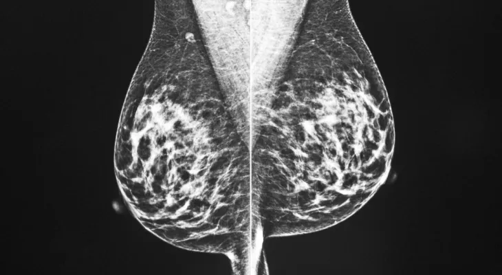 Étude : De nouvelles prévisions révèlent une baisse des taux de cancer et de mortalité au Canada