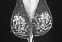 Étude : De nouvelles prévisions révèlent une baisse des taux de cancer et de mortalité au Canada